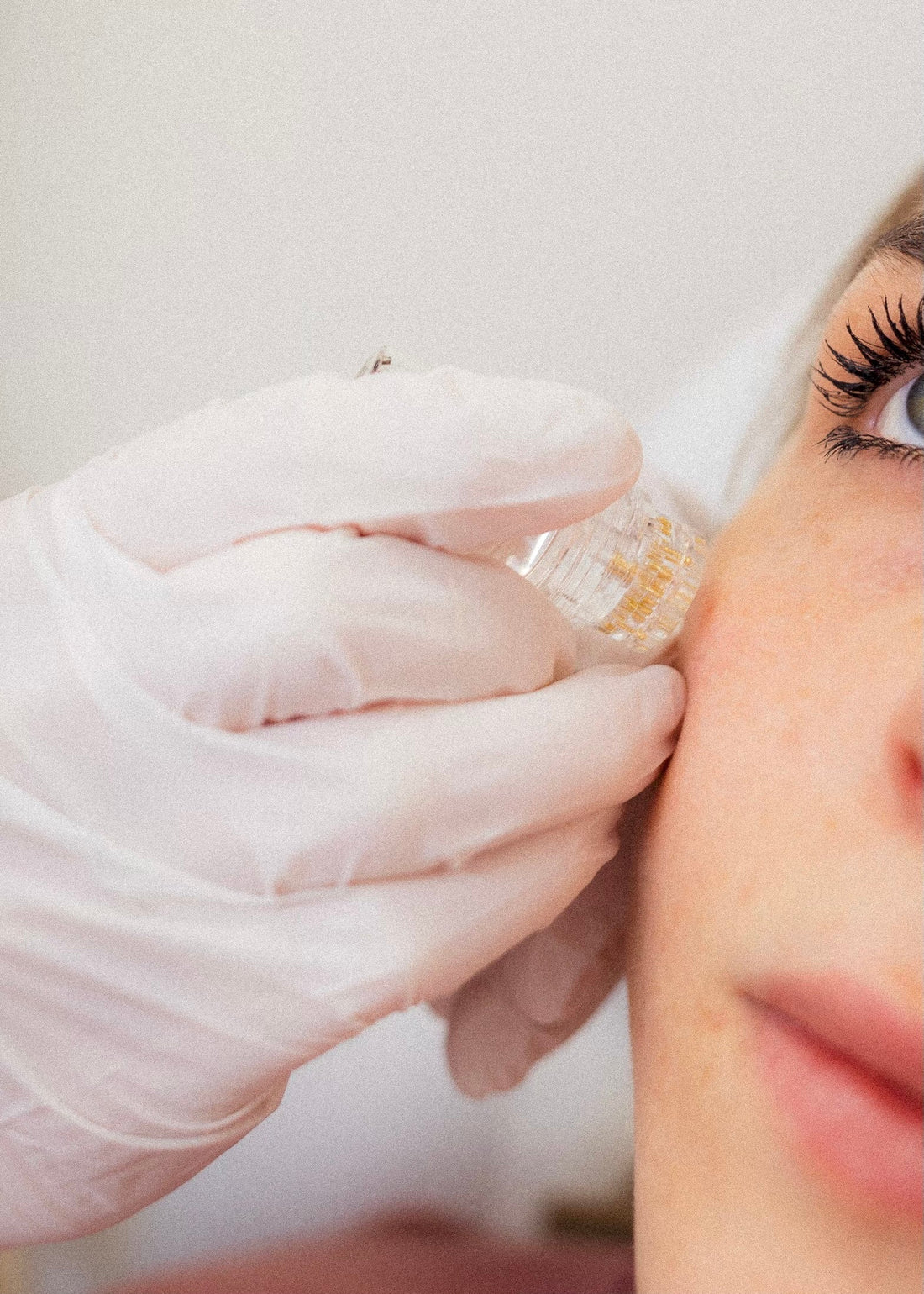 Close-up of a gloved hand performing an AQUAGOLD facial treatment on a woman's cheek using a microneedling device.