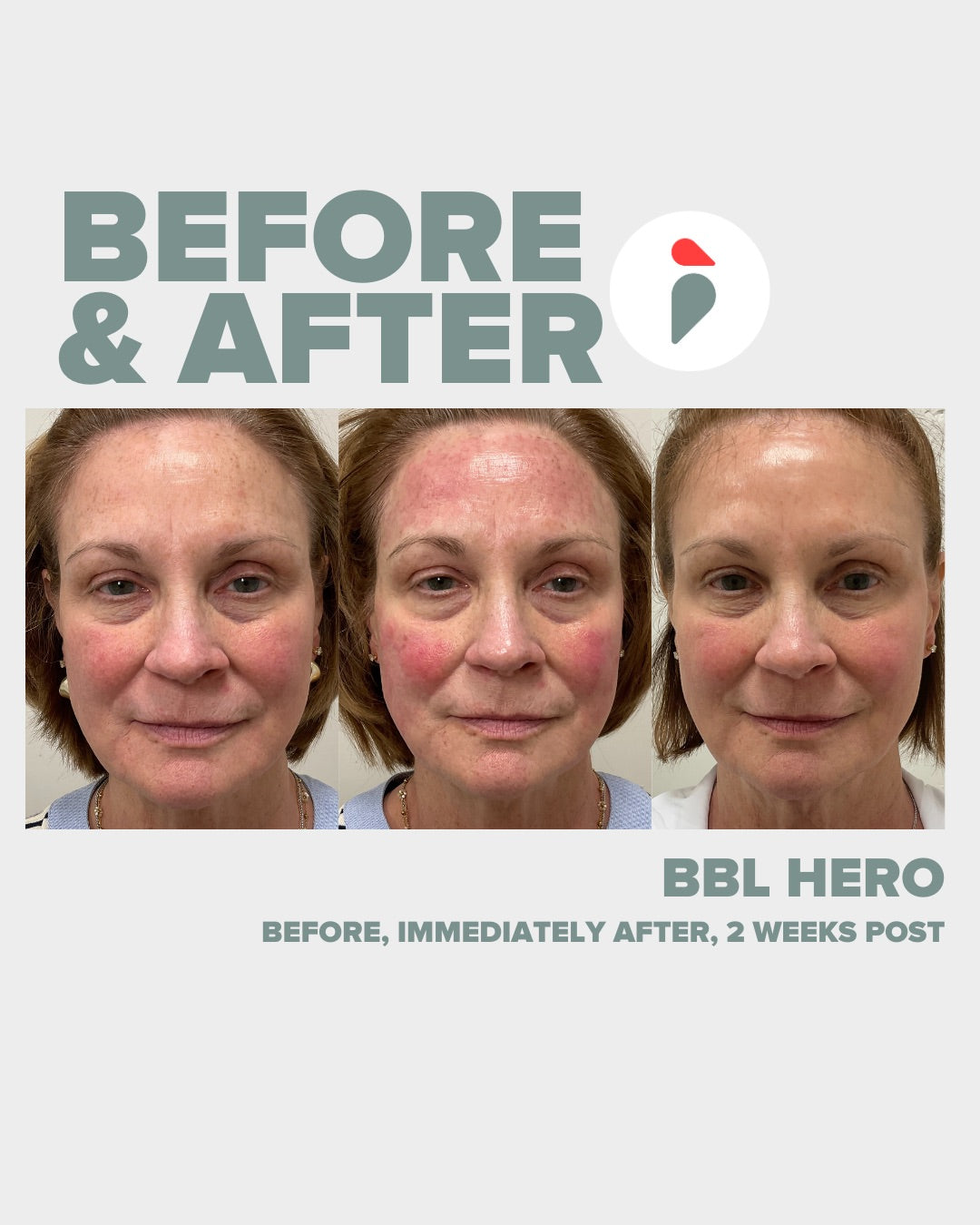 BBL Hero – Nashville patient