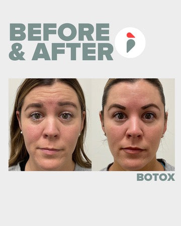Botox – Nashville patient