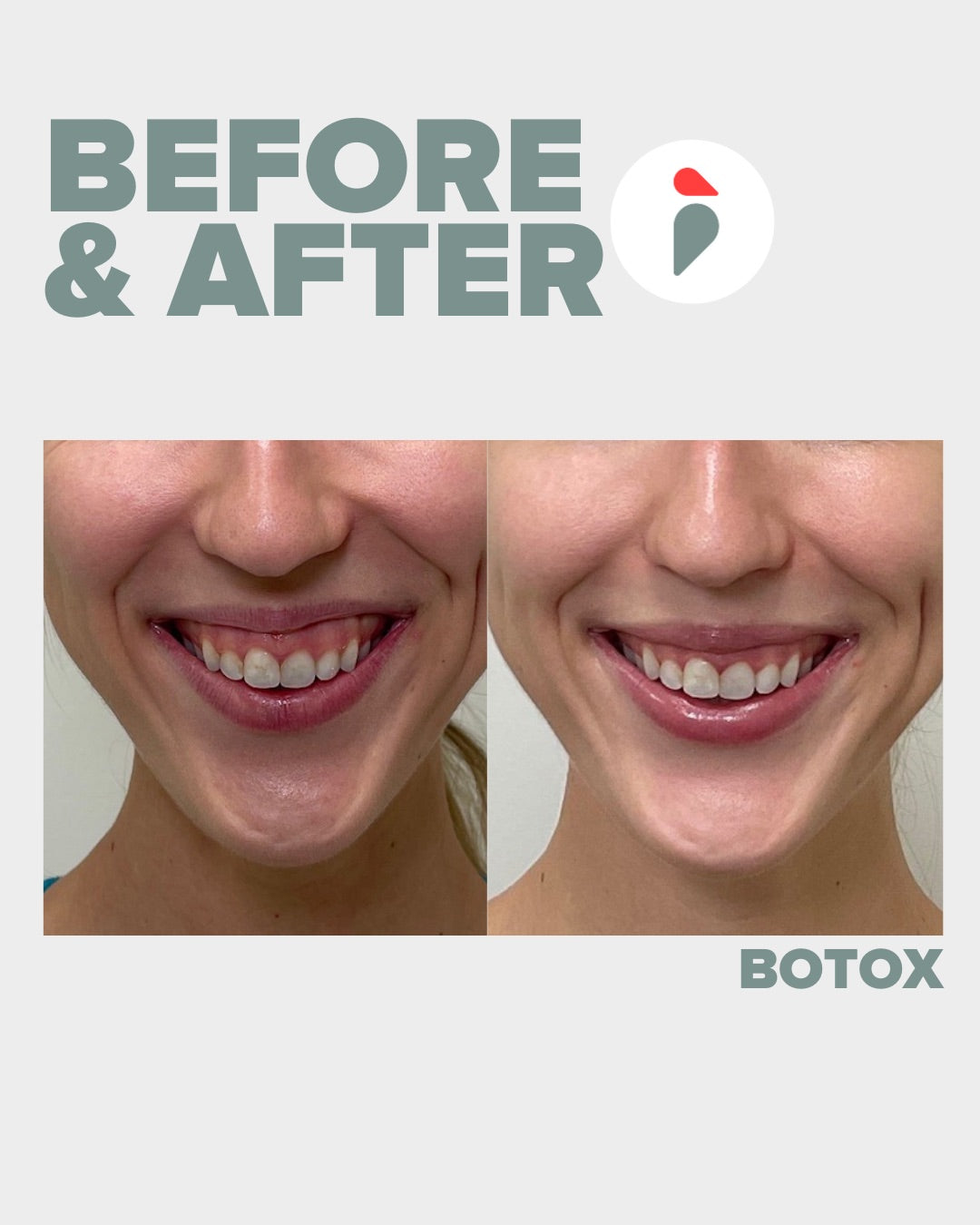Botox – Nashville patient