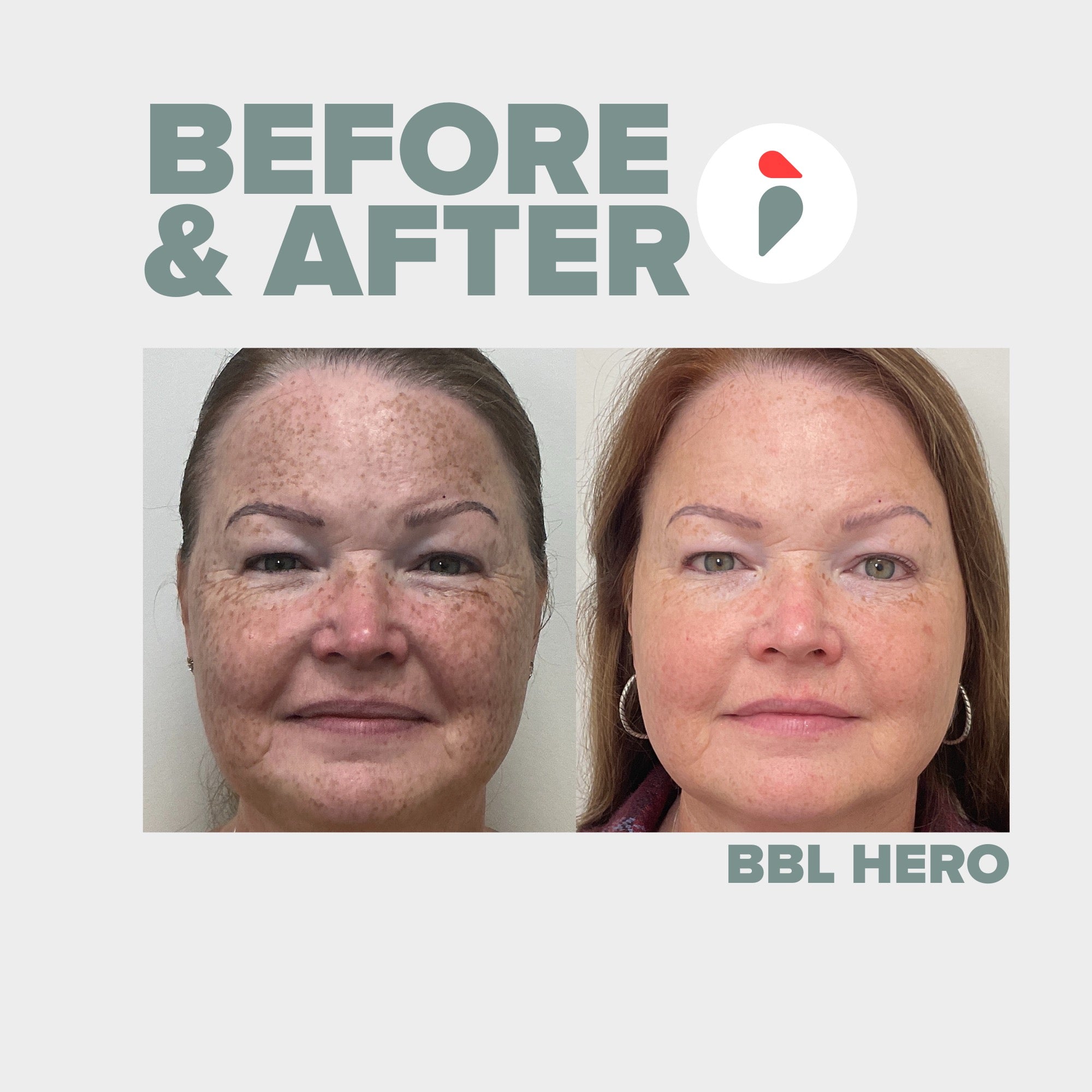 BBL Hero  – Nashville patient