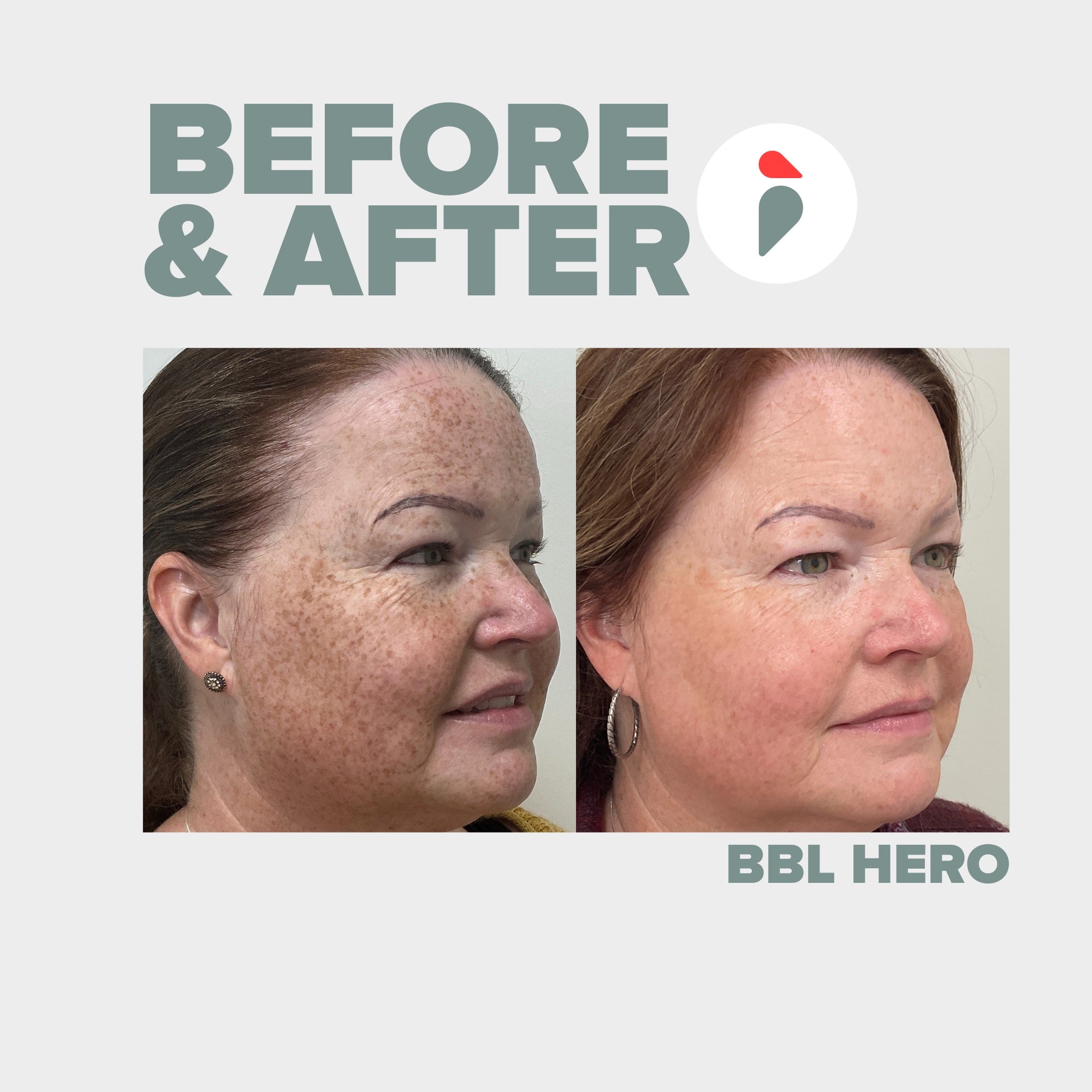 BBL Hero  – Nashville patient