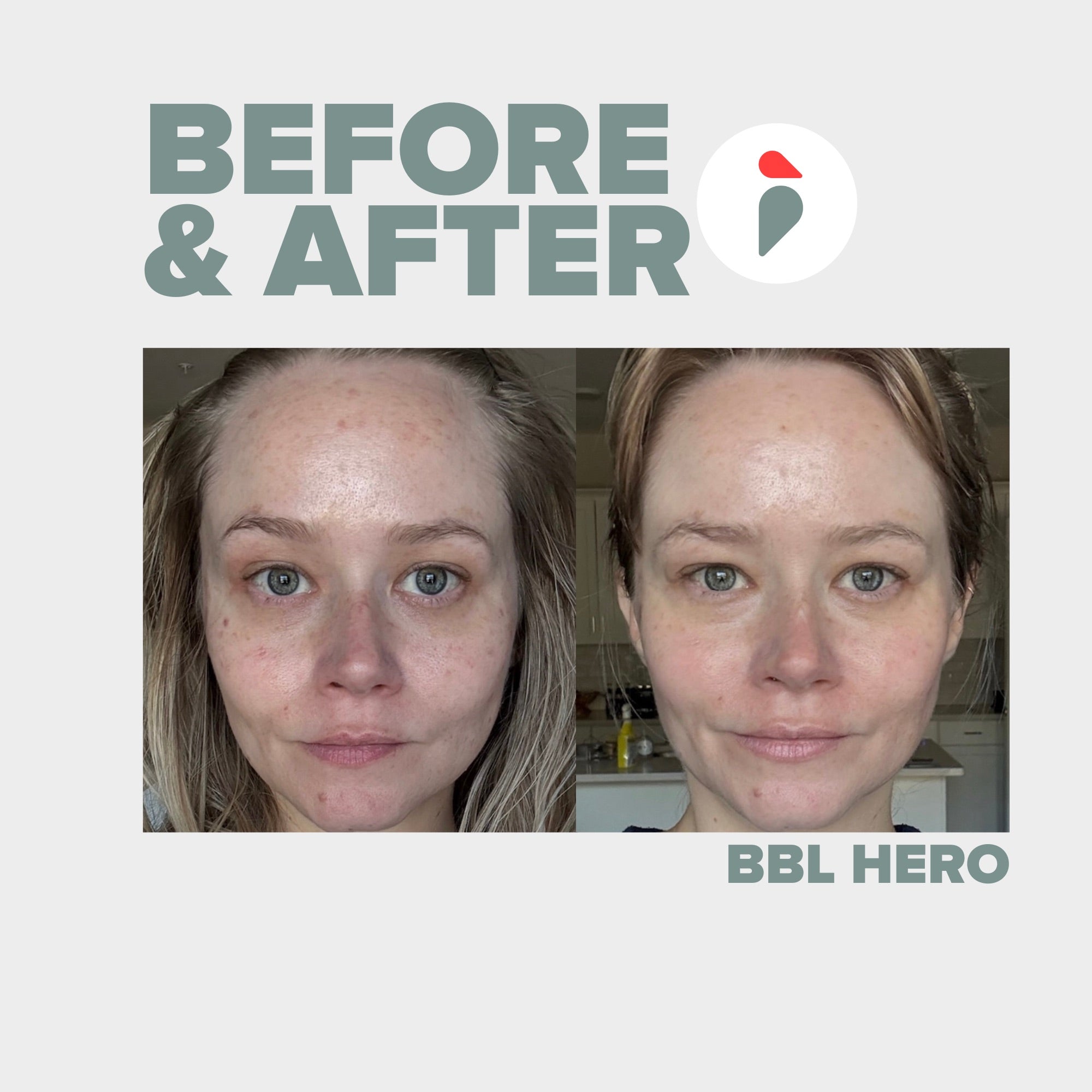 BBL Hero – Nashville patient