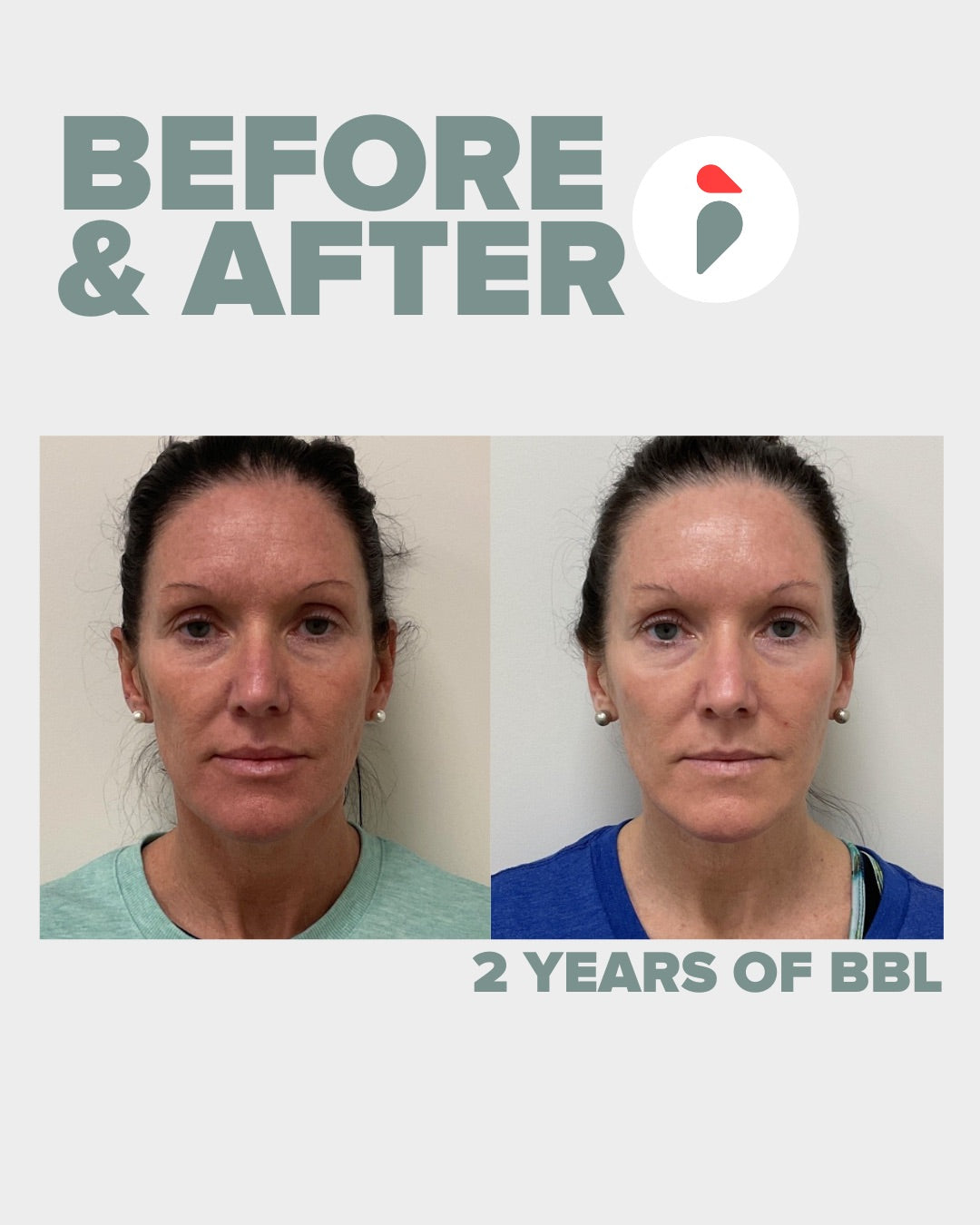 2 Years of BBL Hero – Nashville patient