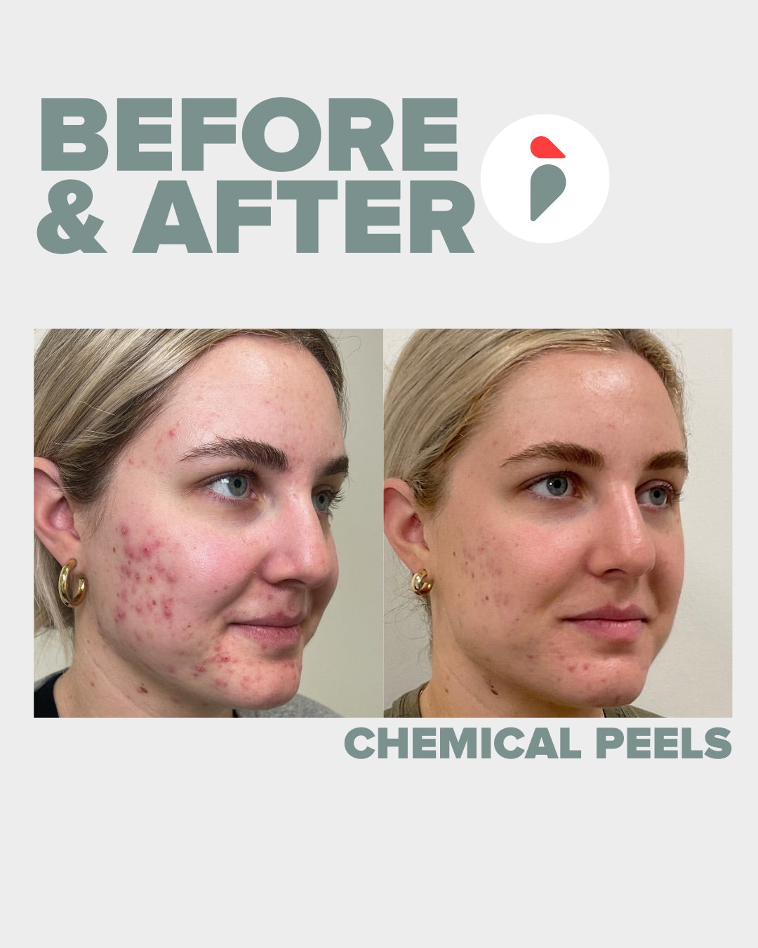 Chemical Peel – Nashville patient