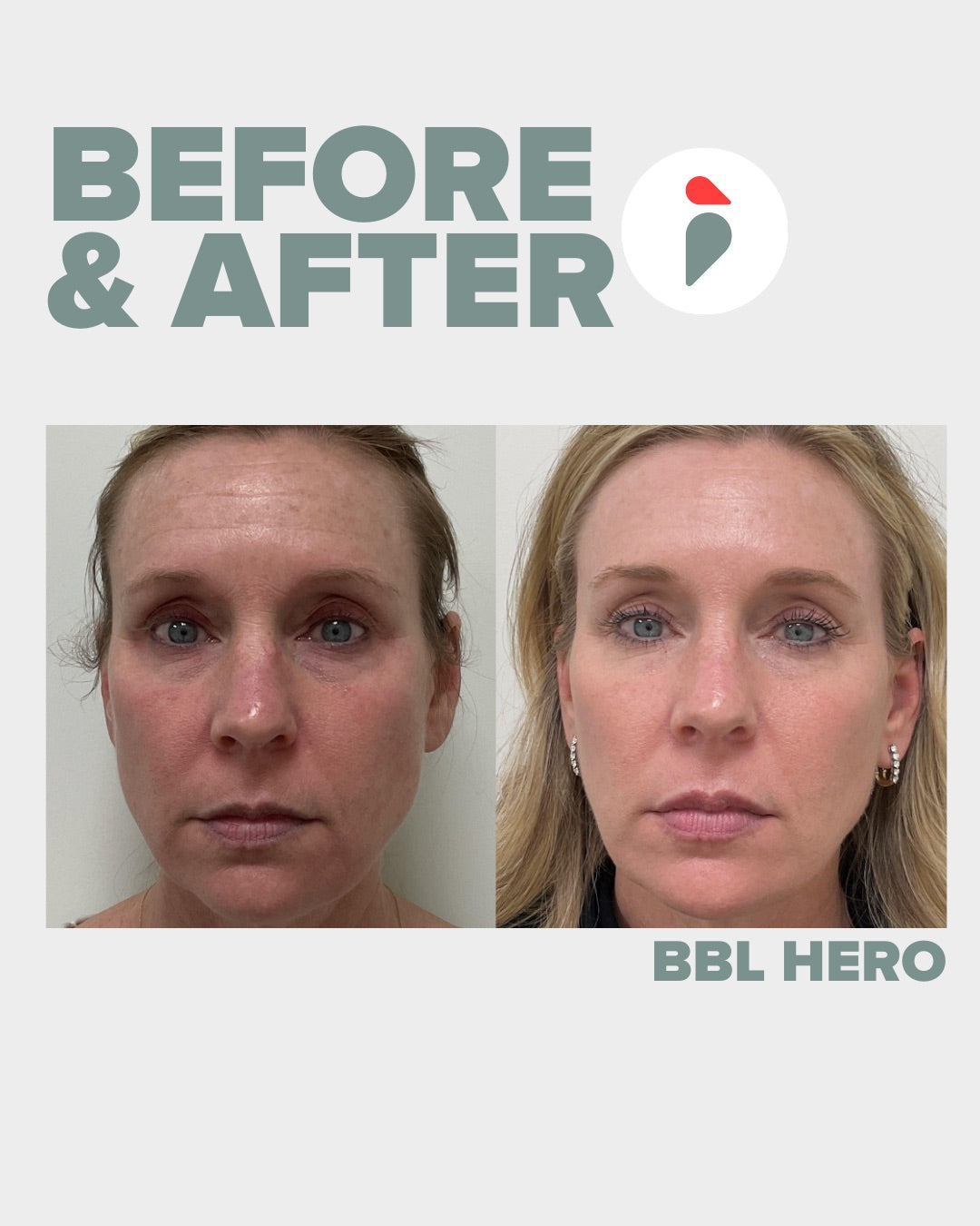 BBL Hero – Nashville patient