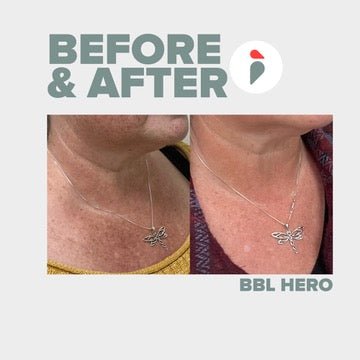 BBL Hero – Nashville patient