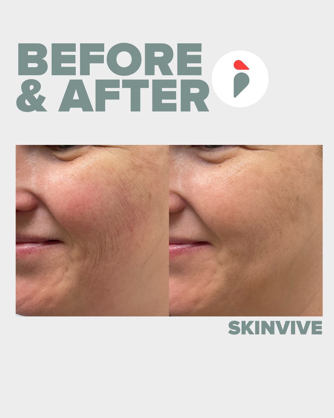Skinvive – Nashville patient