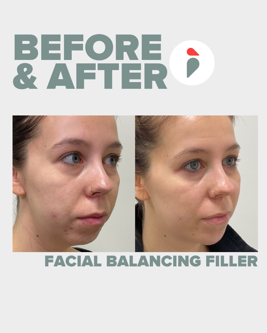Facial Balancing Filler – Nashville patient