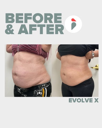 Evolve X – Nashville patient