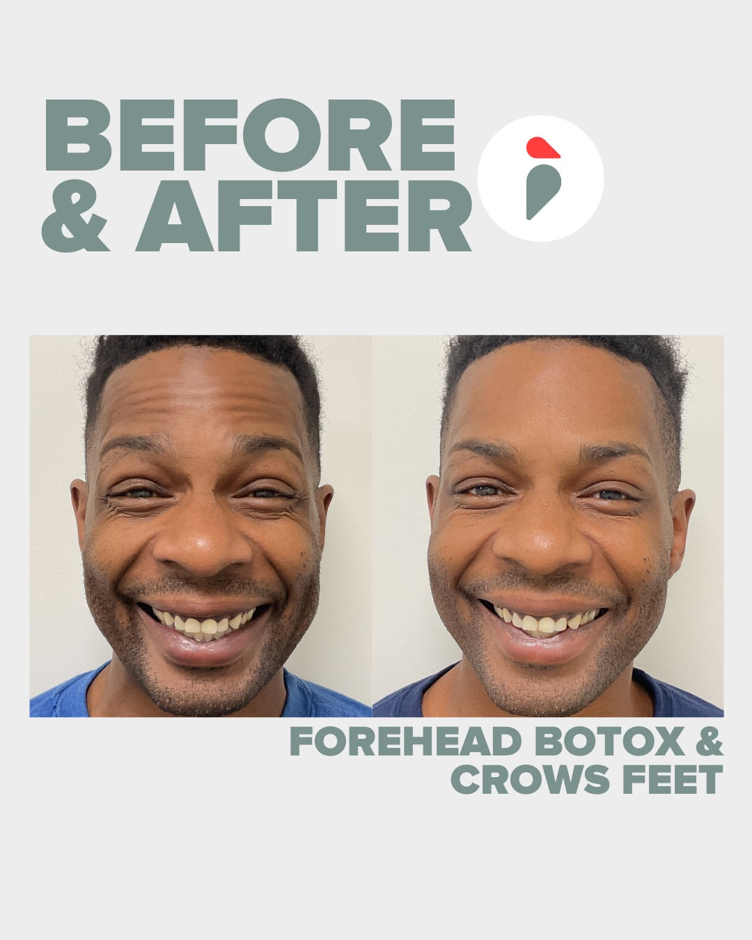 Forehead Botox & Crows Feet – Nashville patient