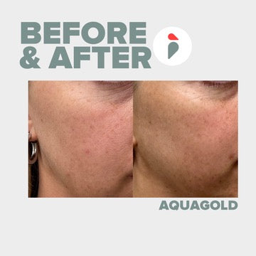 Aquagold – Nashville patient