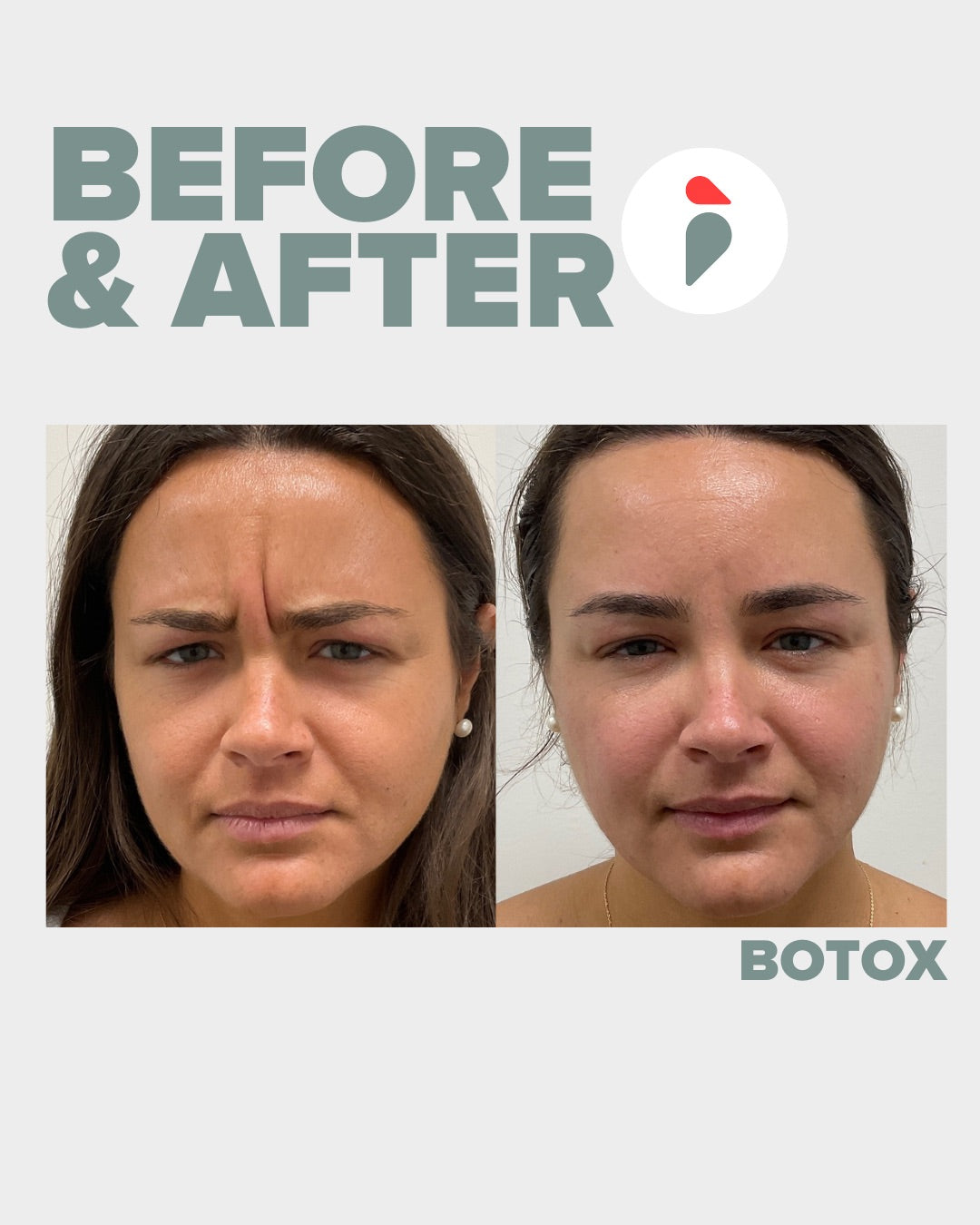 Botox – Nashville patient