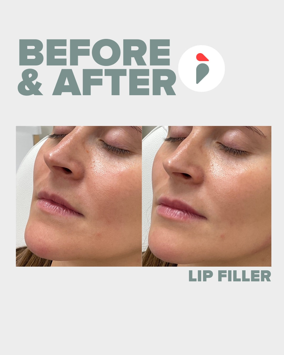Lip Filler – Nashville patient