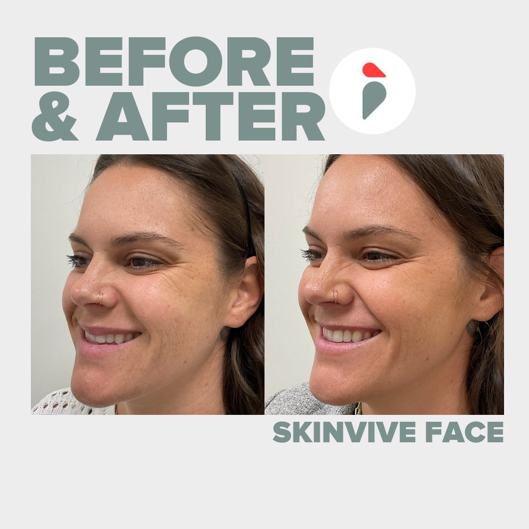 Skinvive – Nashville patient