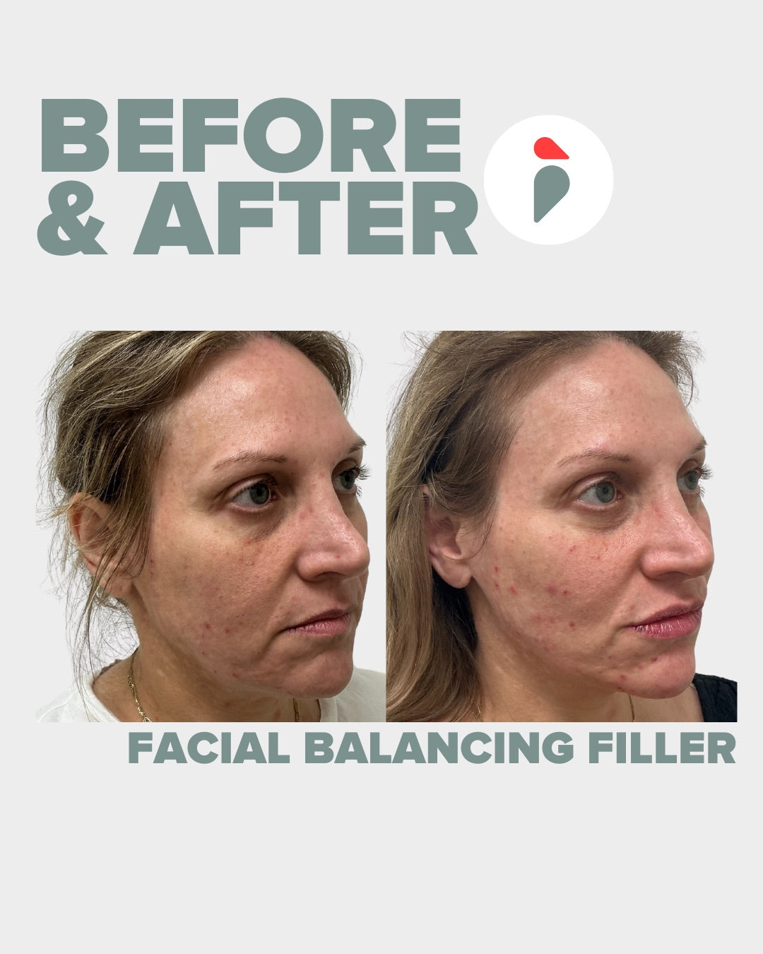Facial Balancing Filler  – Nashville patient