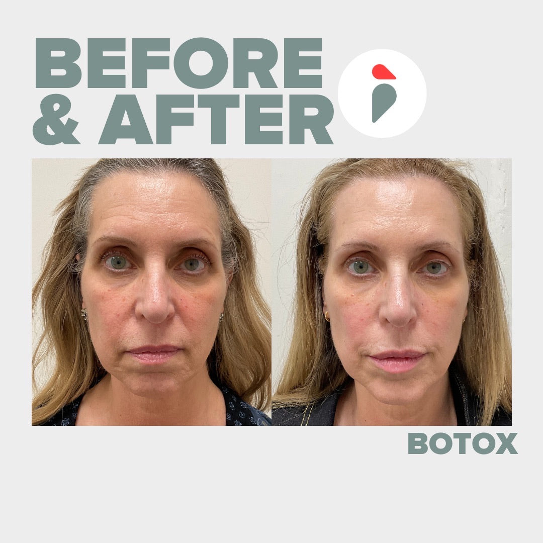 Botox  – Nashville patient
