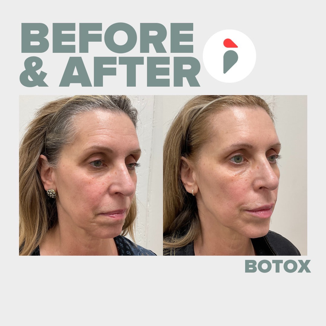 Botox – Nashville patient