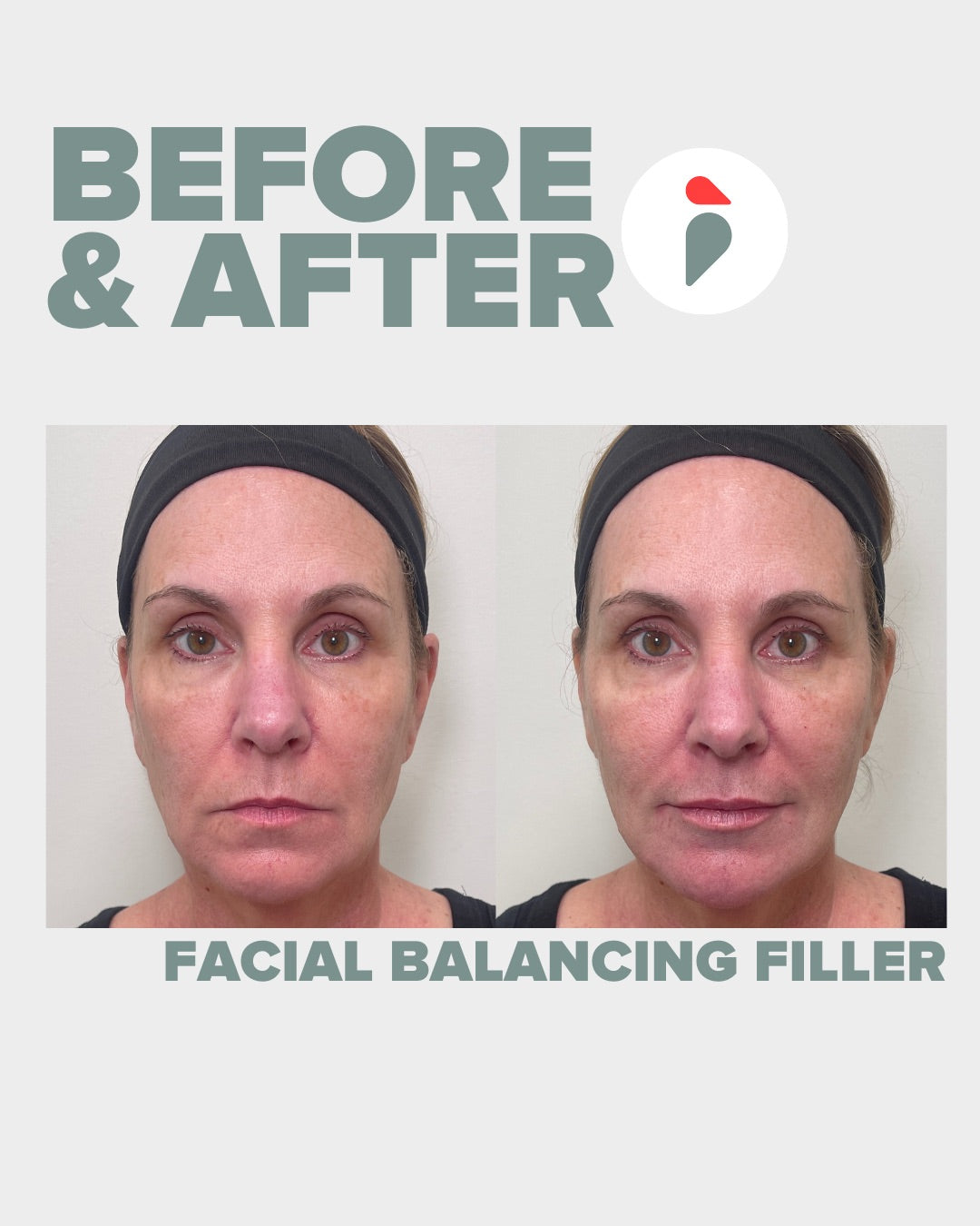 Facial Balancing Filler – Nashville patient