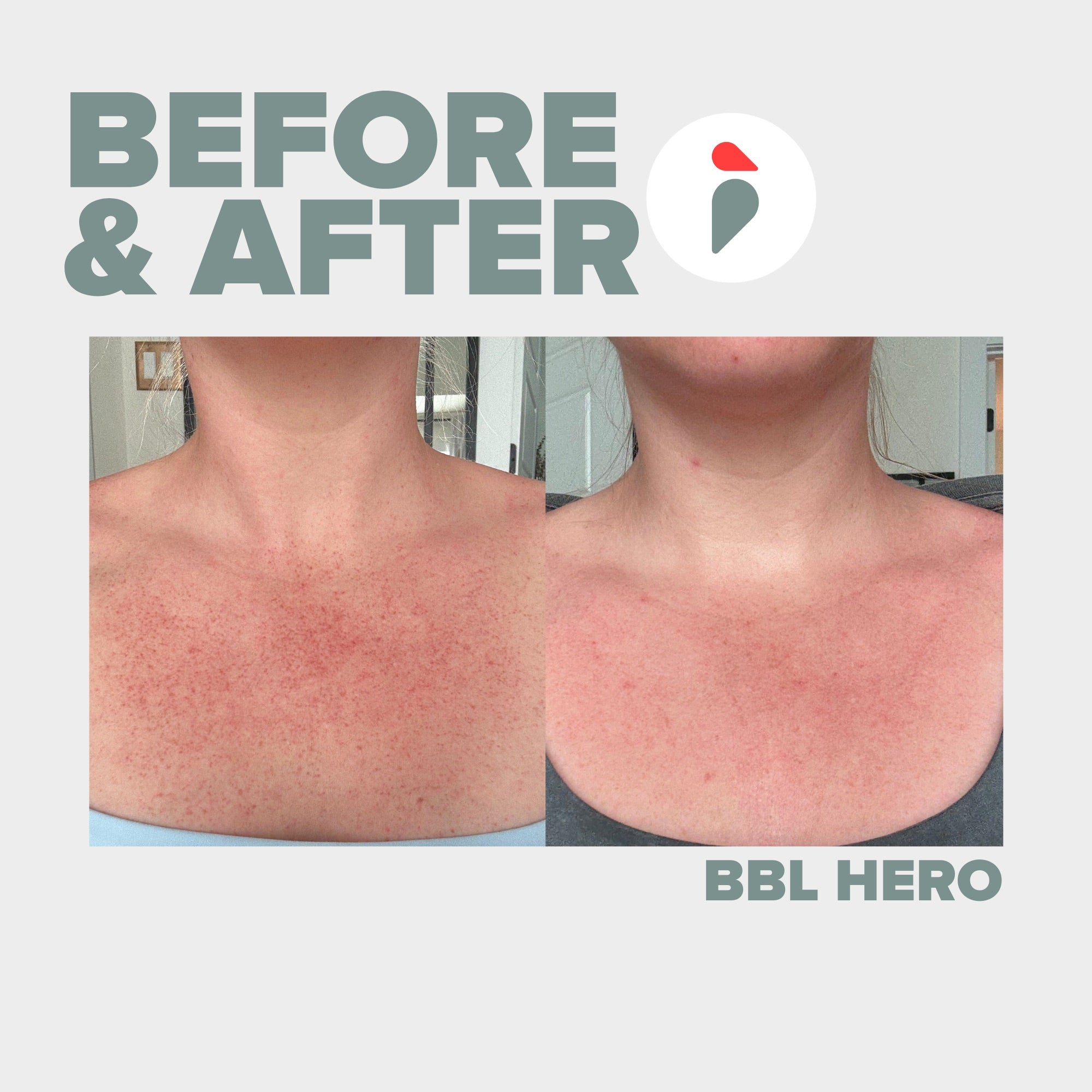 BBL Hero – Nashville patient