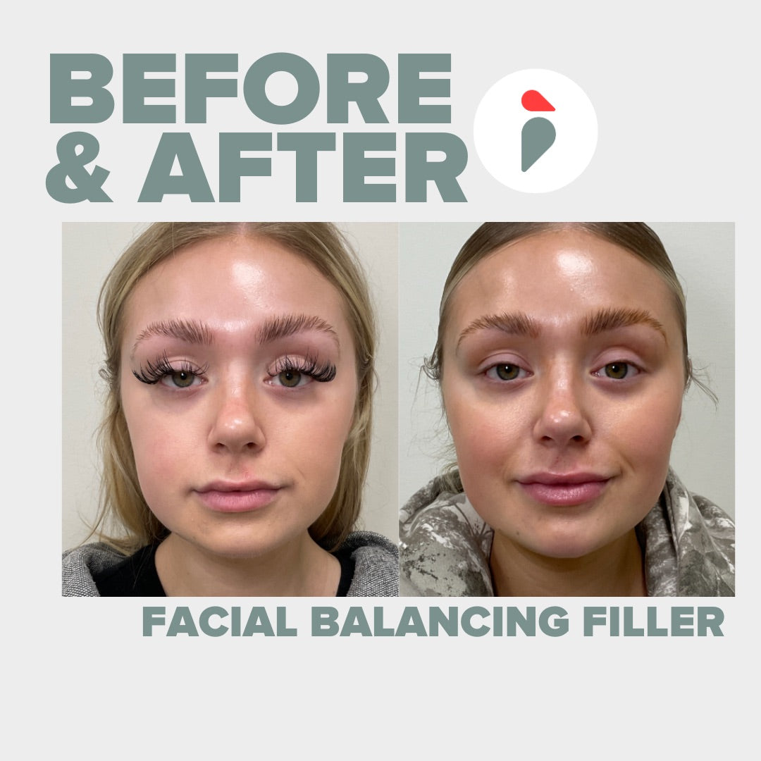 Facial Balancing Filler – Nashville patient