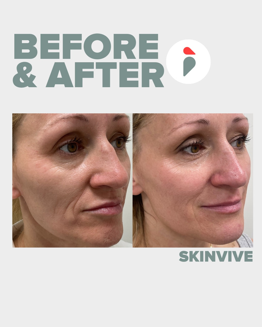 Skinvive – Nashville patient