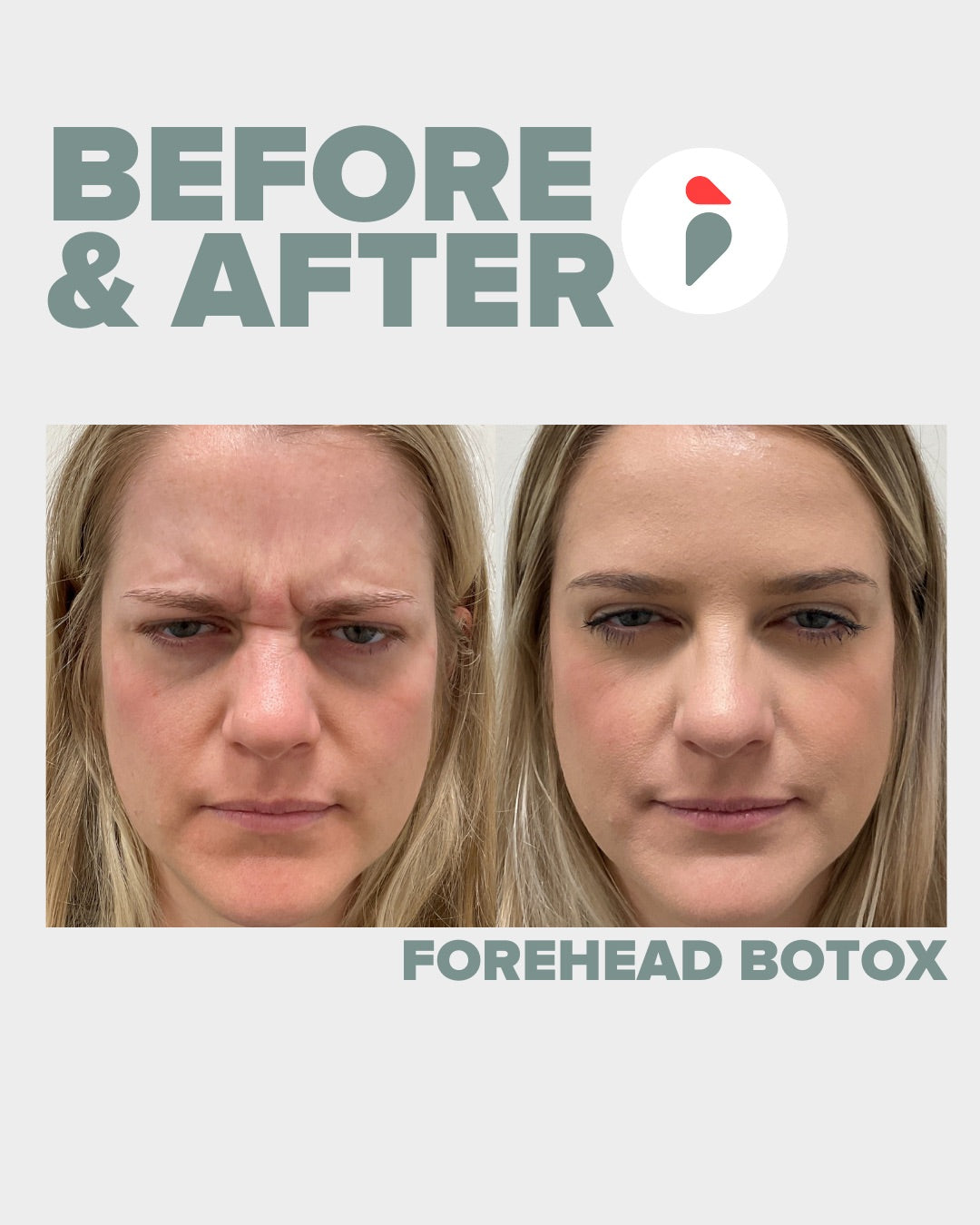 Forehead Botox – Nashville patient