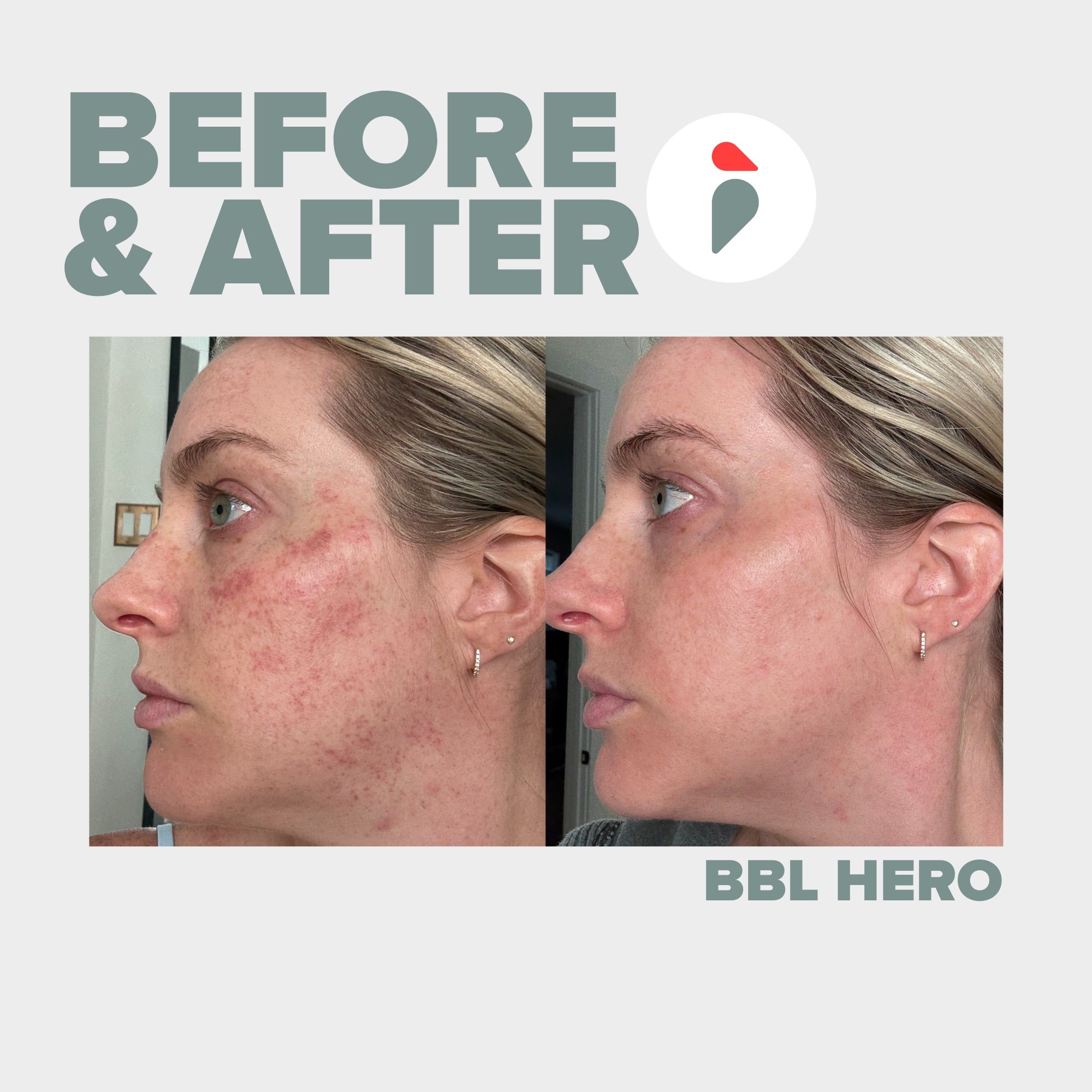 BBL Hero – Nashville patient