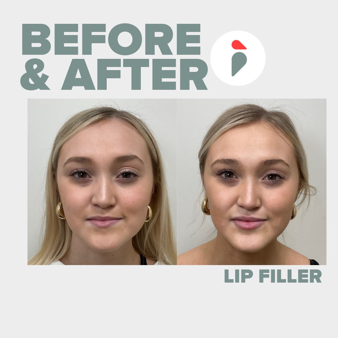 Lip Filler – Nashville patient