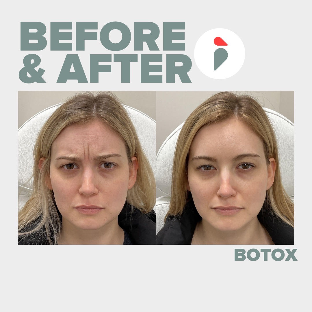 Botox forehead lines – Nashville patient