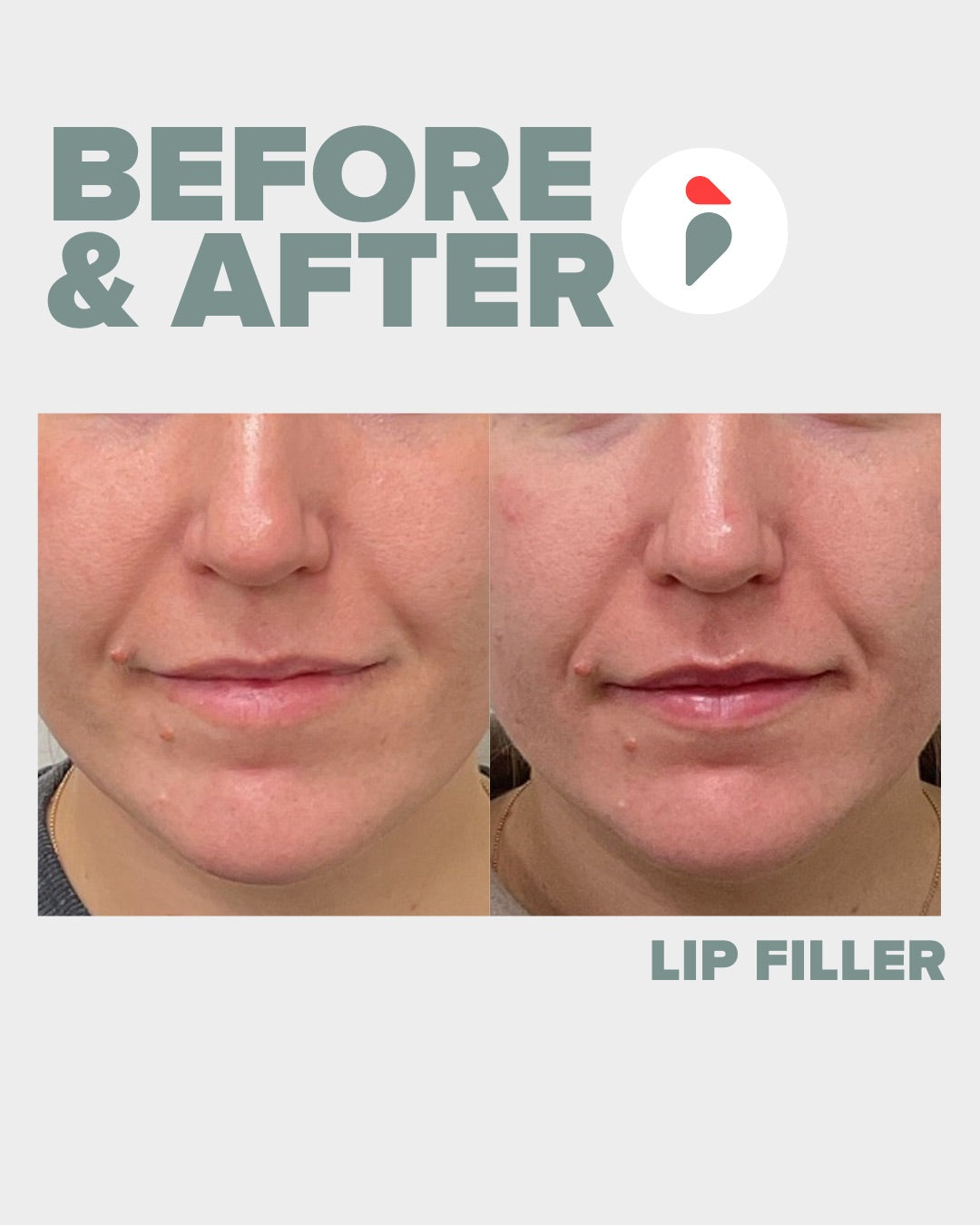 Lip Filler – Nashville patient