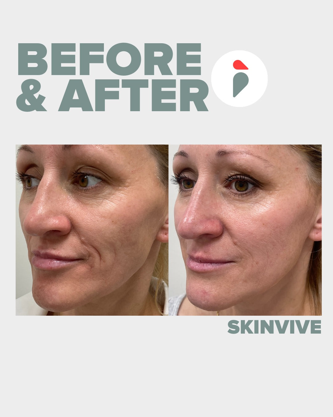 Skinvive – Nashville patient