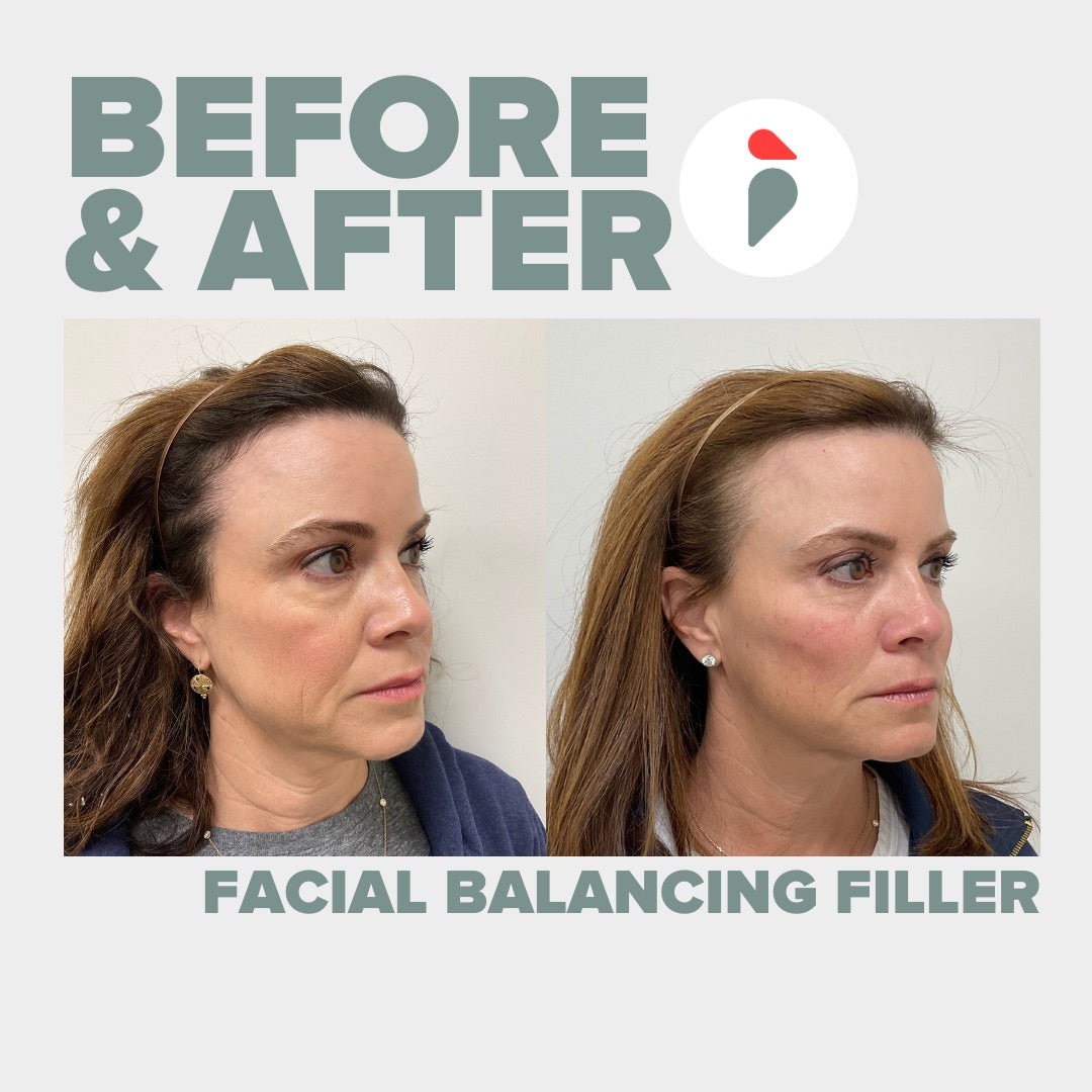 Facial Balancing Filler  – Nashville patient