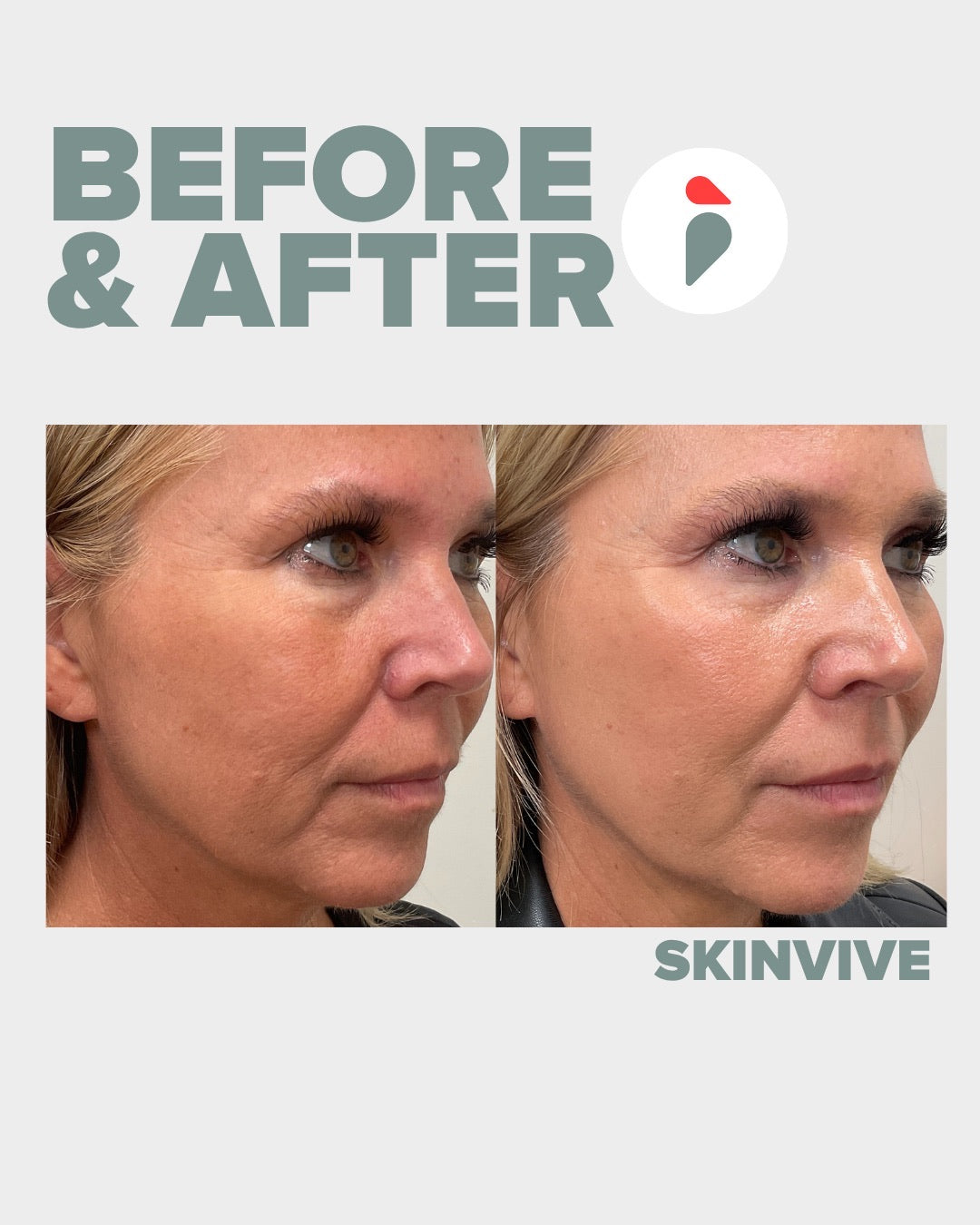 Skinvive – Nashville patient