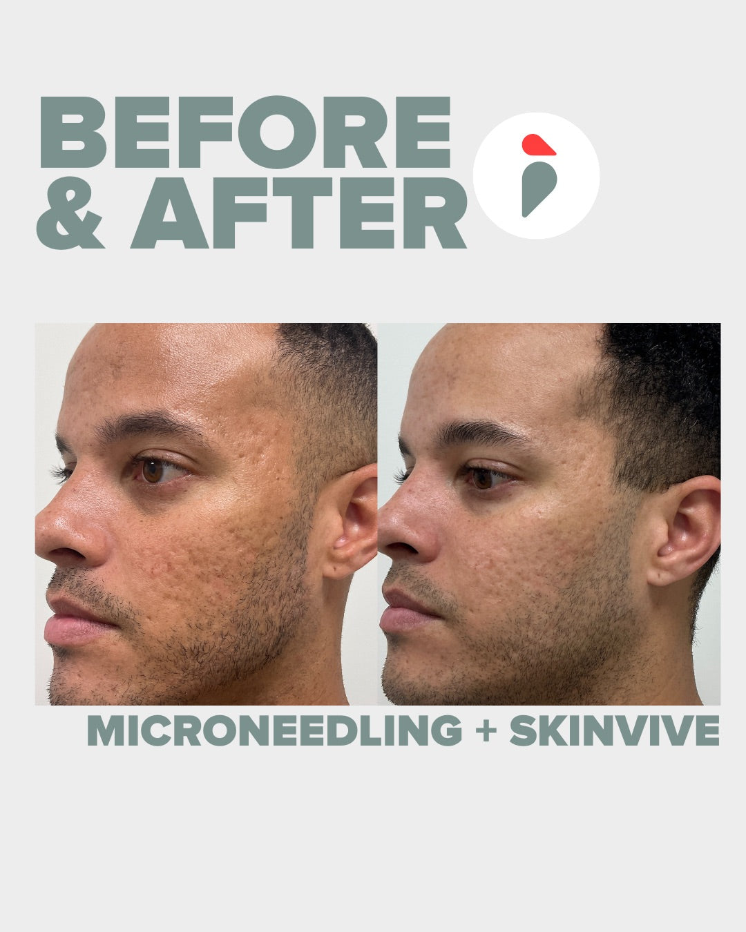 Microneedling + Skinvive – Nashville patient