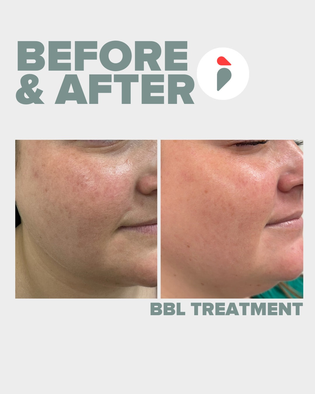 BBL Hero – Nashville patient