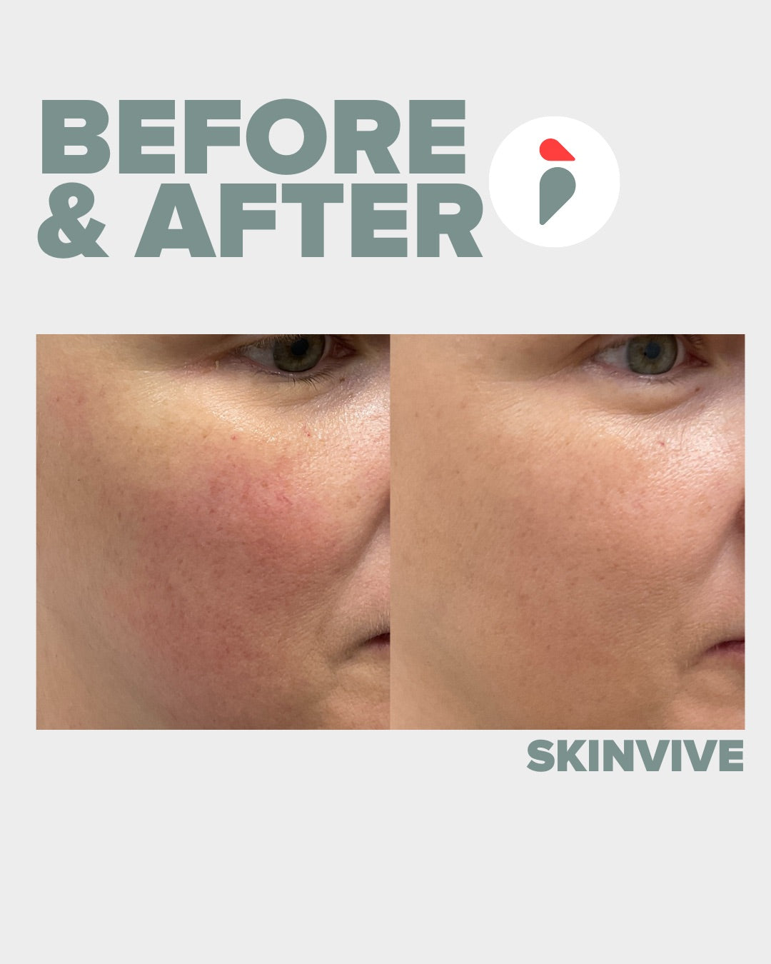 Skinvive – Nashville patient