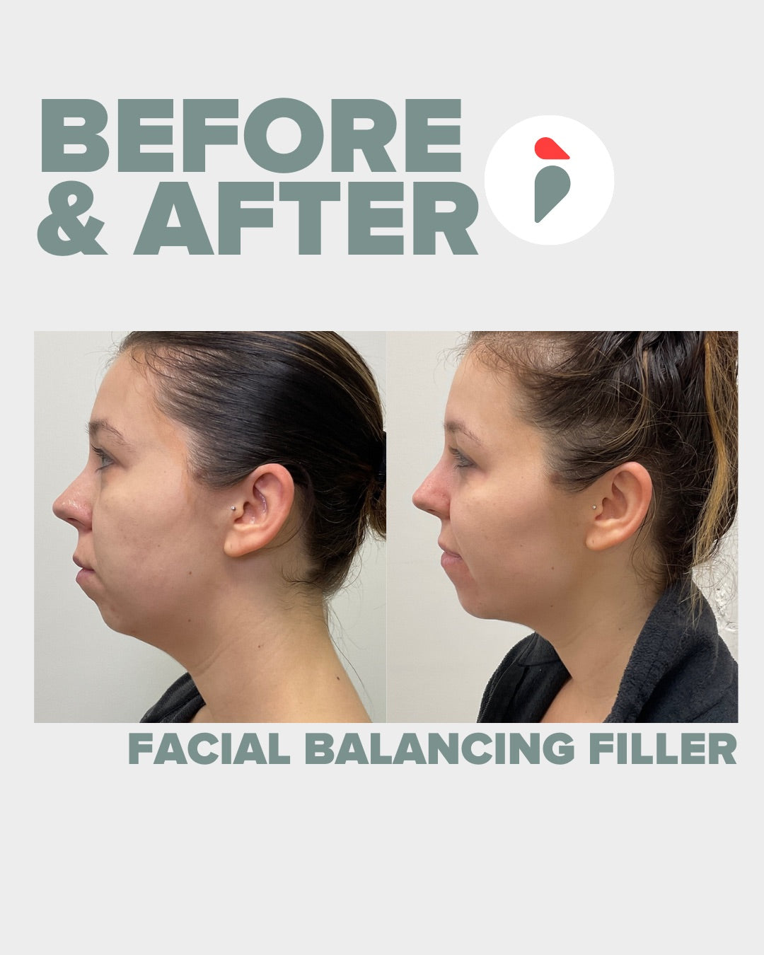 Facial Balancing Filler – Nashville patient