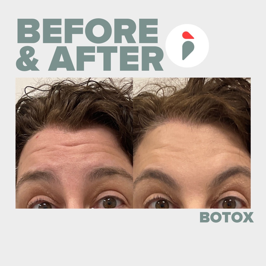 Botox – Nashville patient