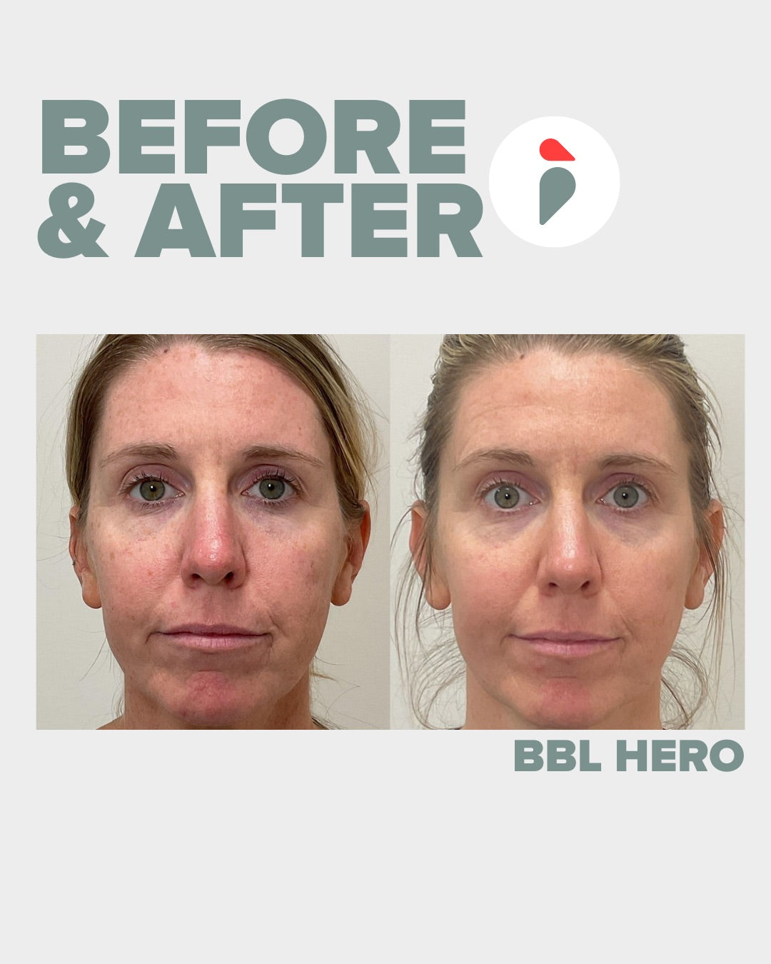 BBL Hero – Nashville patient