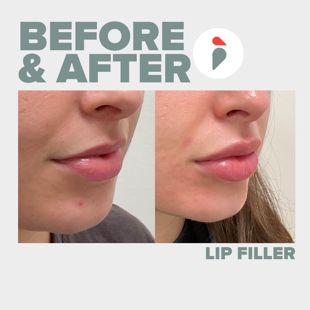 Lip Filler – Nashville patient