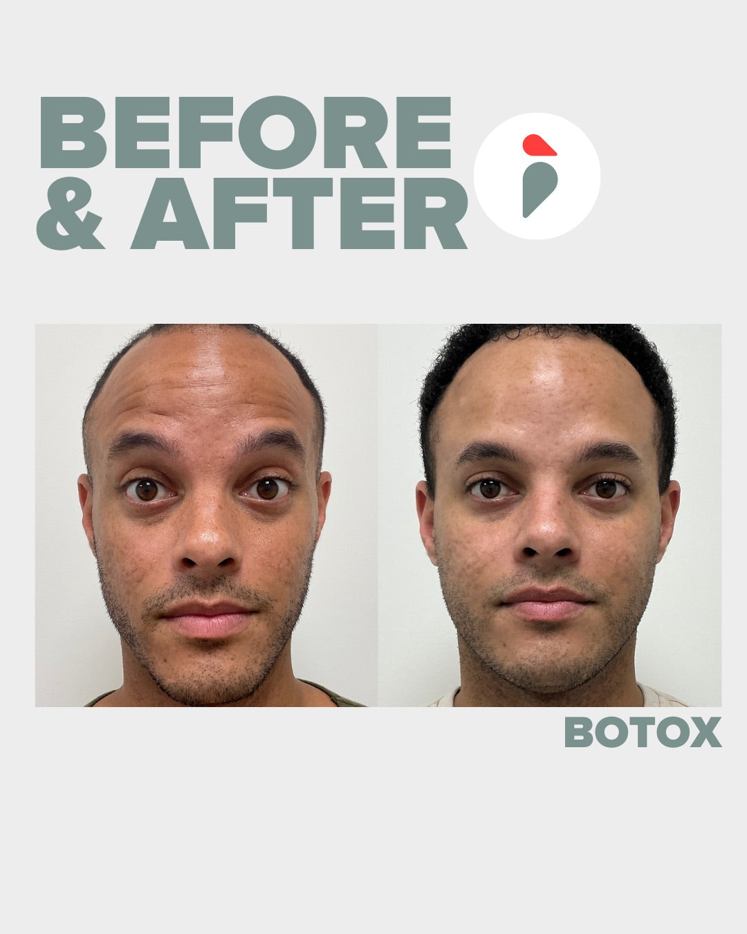 Botox – Nashville patient