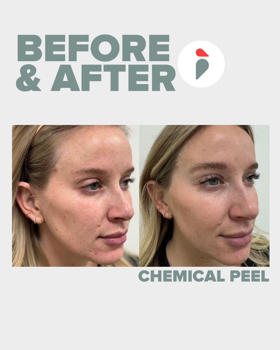 Chemical Peel – Nashville patient