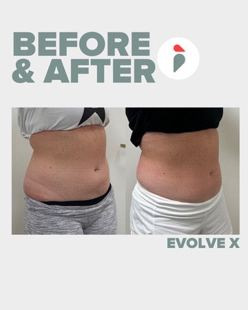 Evolve X – Nashville patient