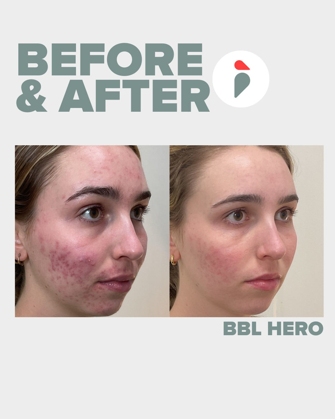 BBL Hero  – Nashville patient