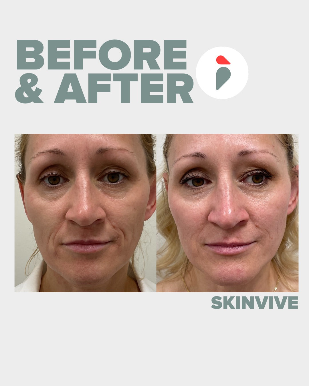 Skinvive – Nashville patient