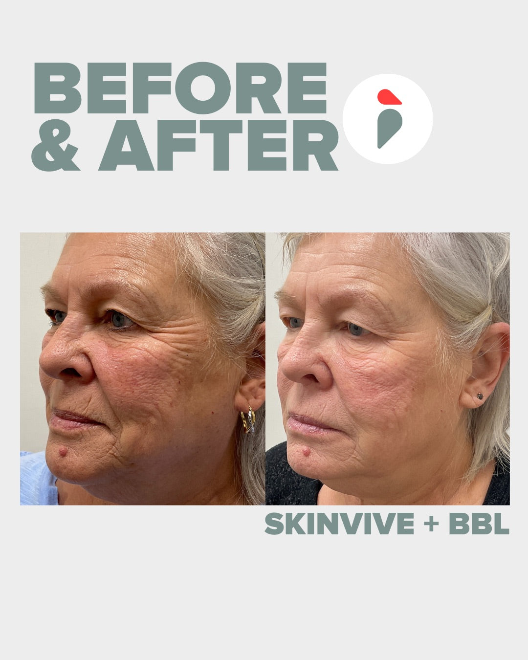 Skinvive + BBL Hero – Nashville patient