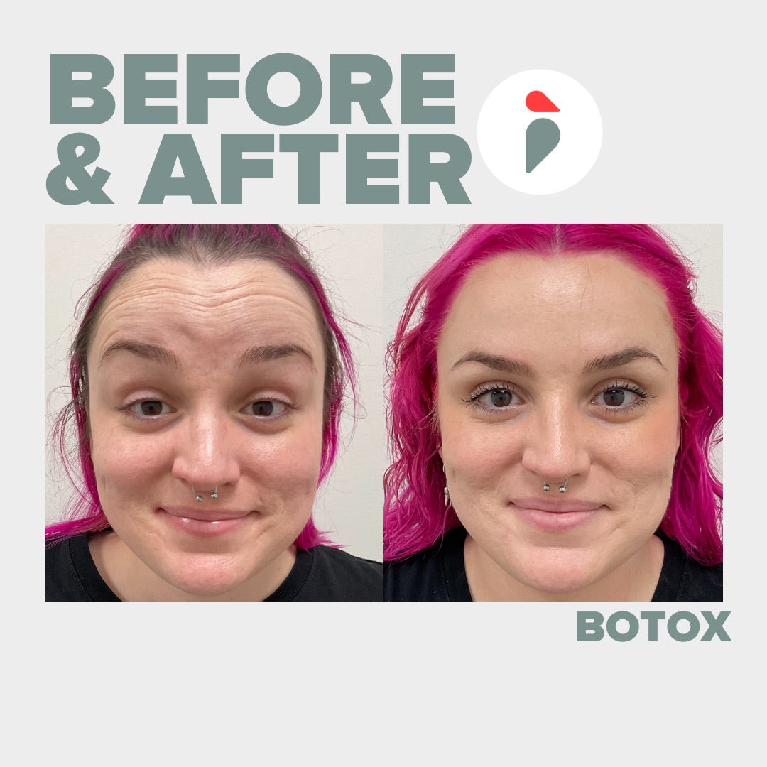 Botox – Nashville patient