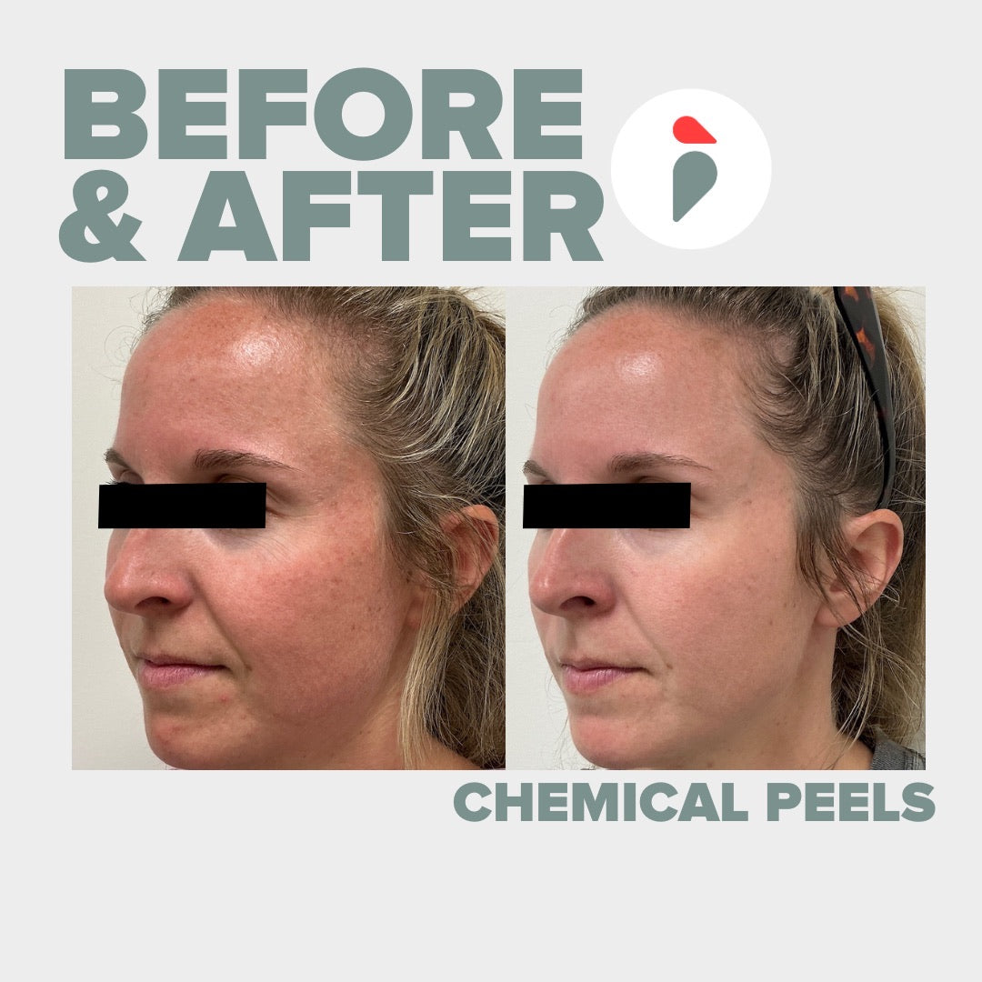 Chemical Peel – Nashville patient