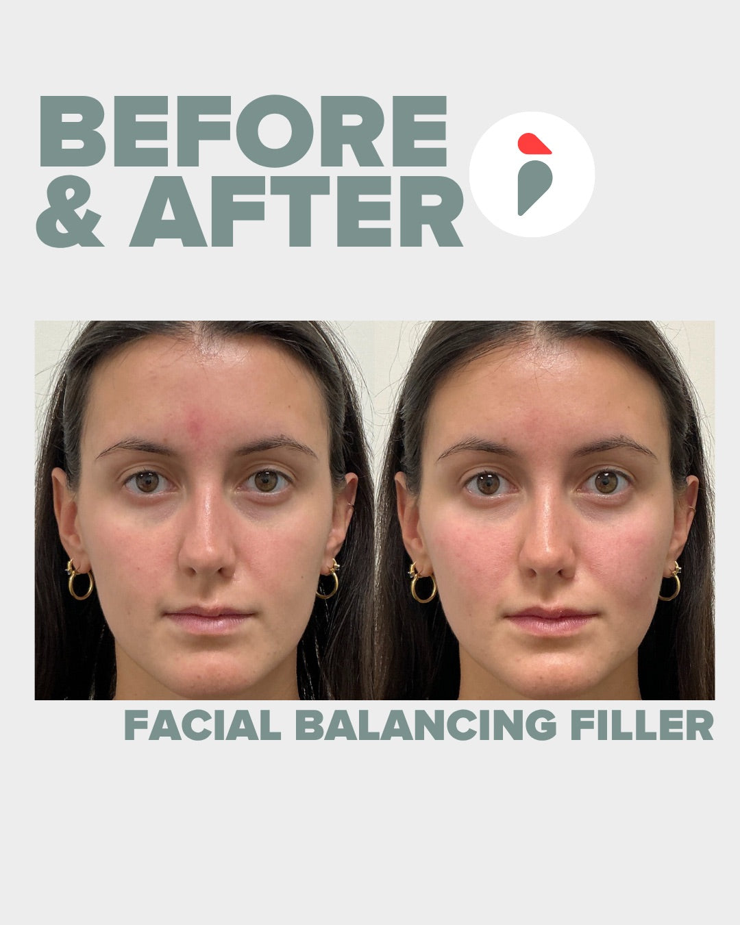 Facial Balancing Filler – Nashville patient